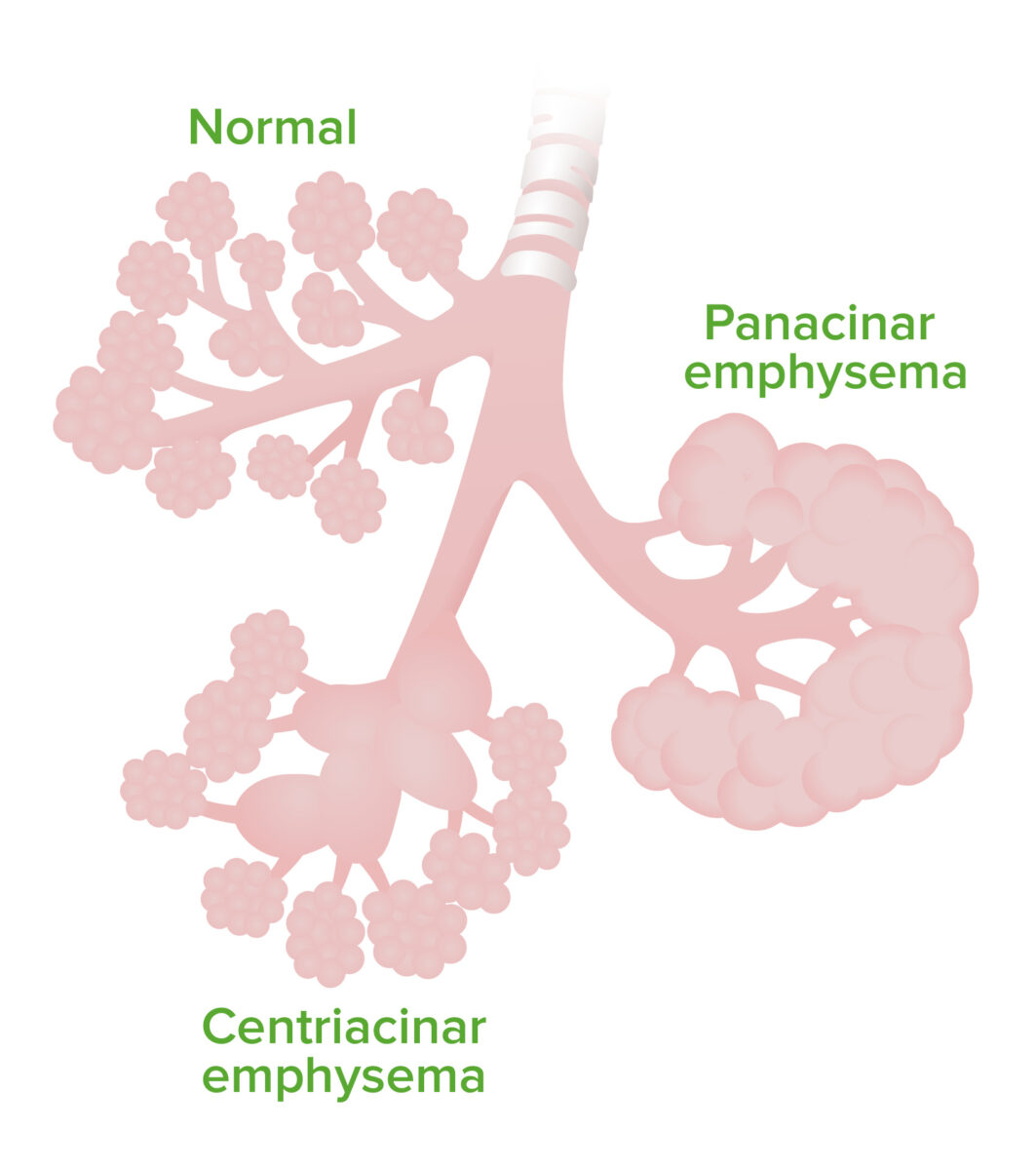 Emphysema pathophysiology