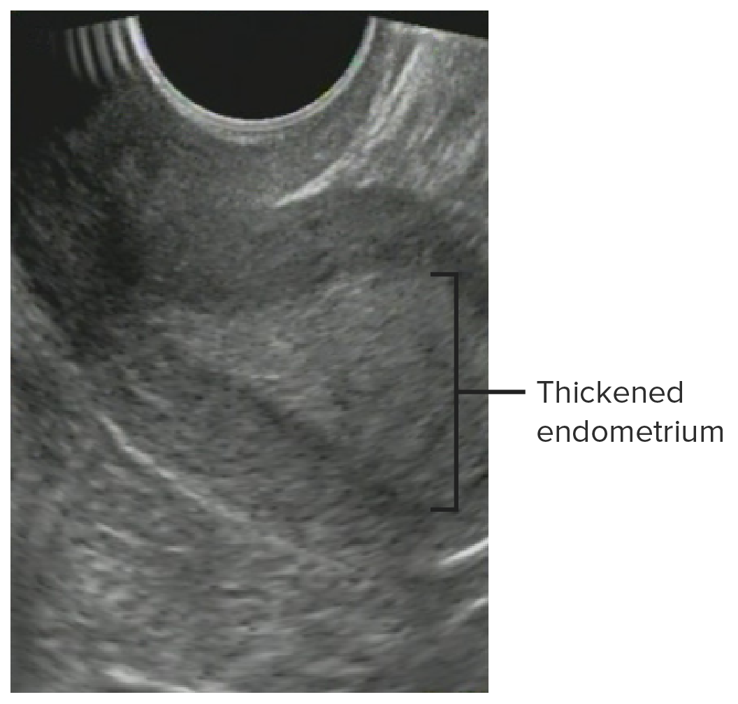 Endometrial thickening consistent with endometrial hyperplasia