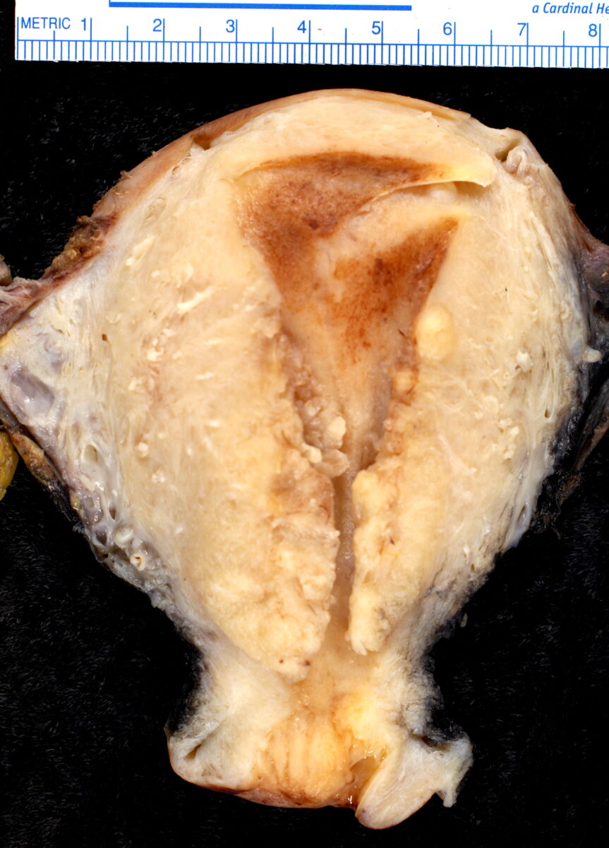 Endometrioid adenocarcinoma, gross specimen