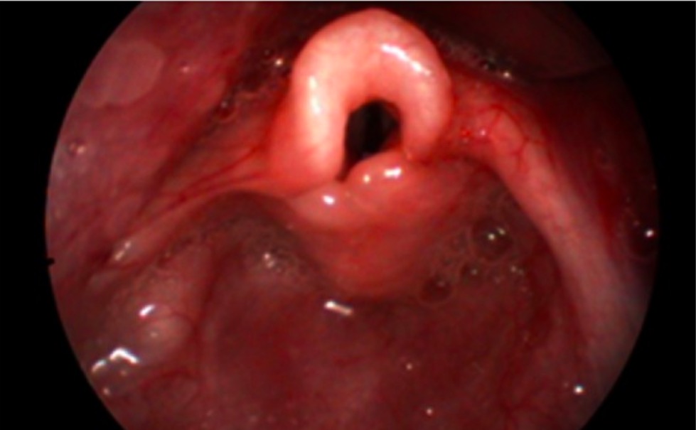 Endoscopic features of laryngomalacia