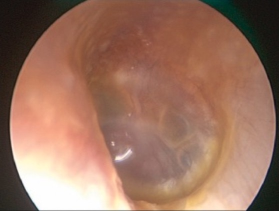 Endoscopic view of beginning otitis media of the left middle ear