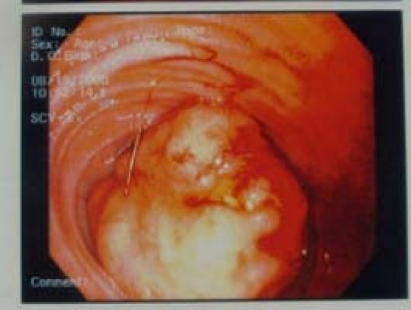Endoscopic view of the carcinoid tumor