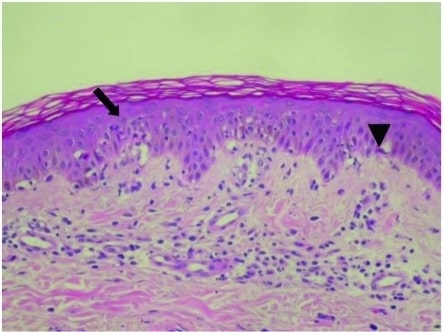 Erythema Multiforme Oral Histology