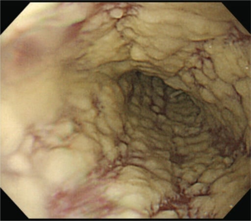 Premium Photo  Rash on the breast of a young woman caused by candida  fungus blisters caused by virus or yeasts