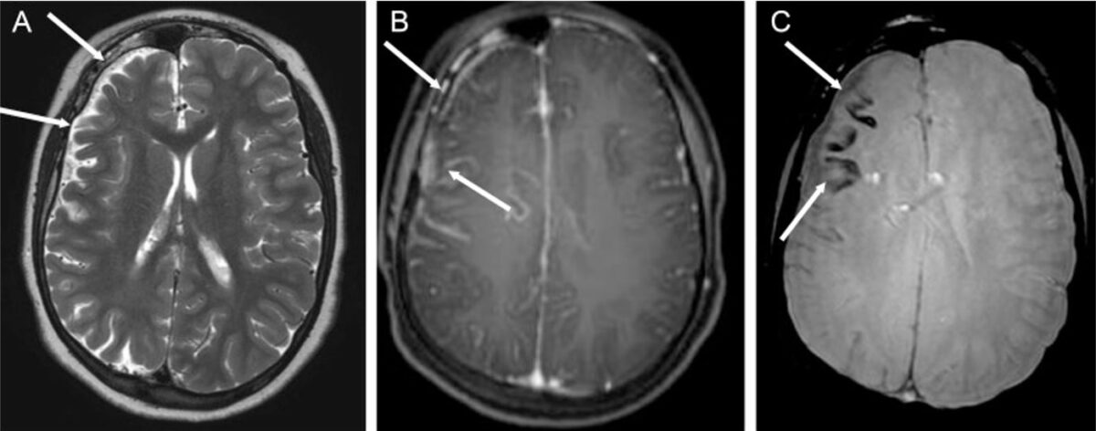 Epilepsy associated with sws