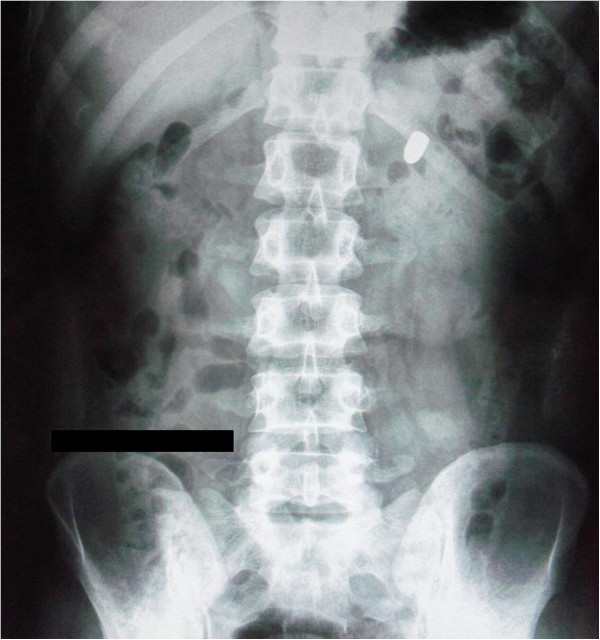 Erect abdominal radiograph showing bullet
