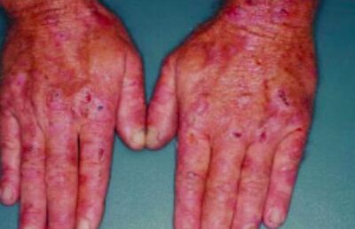 Erosions, crust, and blisters are evident on the hands of this patient with pct