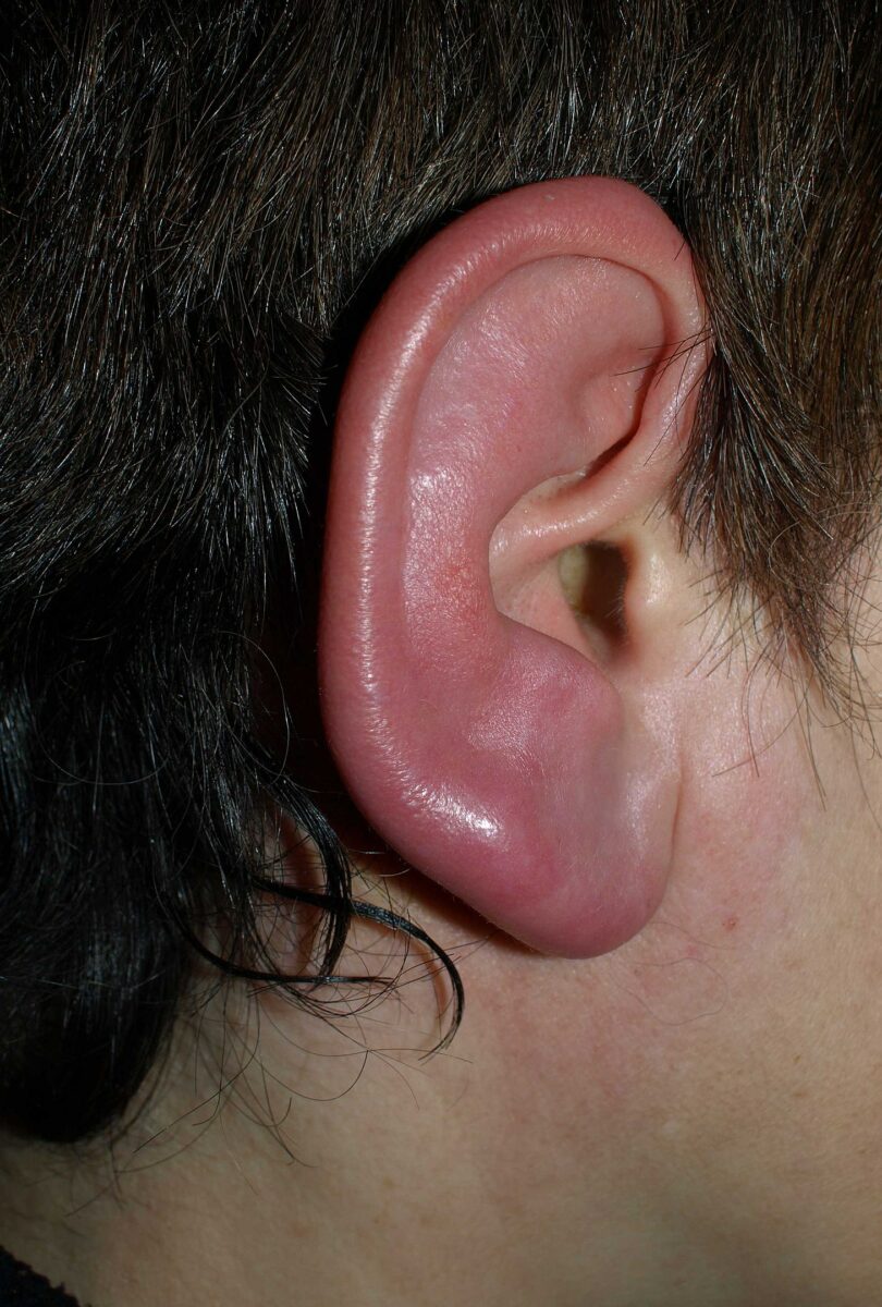 Erysipelas of the ear