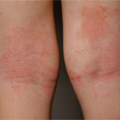 Erythema and lichenification in the kneefolds of a patient with atopic dermatitis