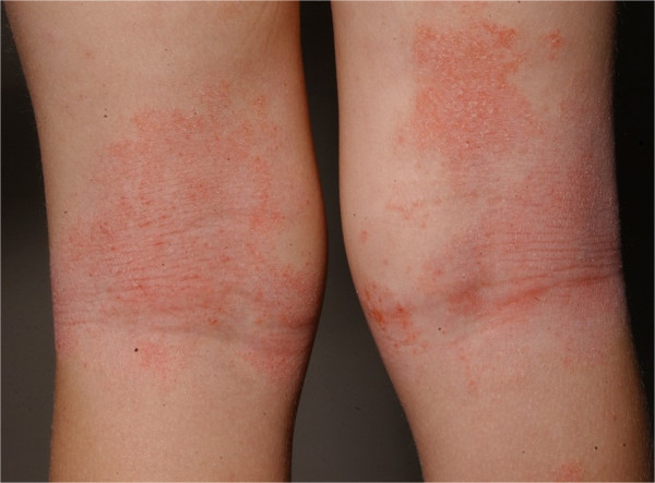 a) Day 1, patient presents with flat erythematous rash with scattered