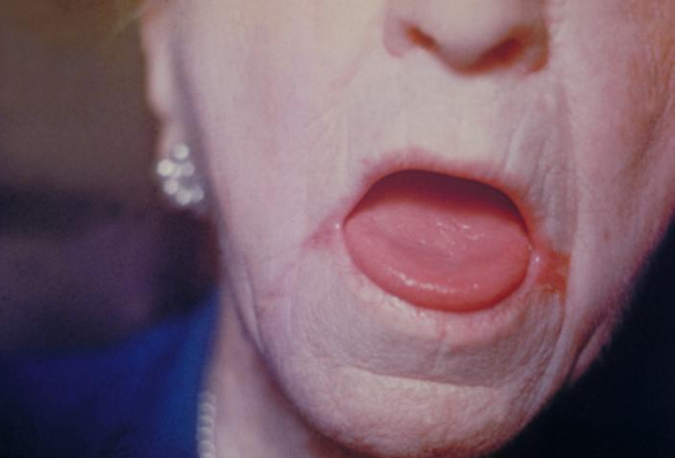 Erythematous lesions at the corners of mouth due to oral candidiasis