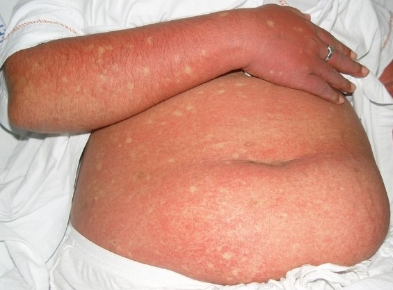 Erythematous rash dengue fever virus flaviviridae