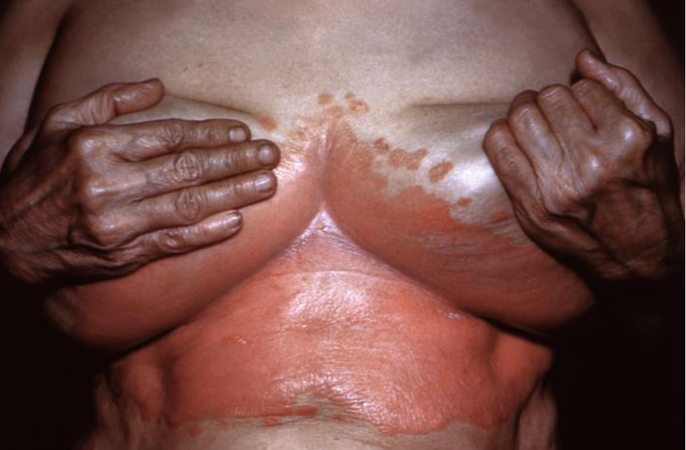 Erupción eritematosa bajo las mamas debido a la candidiasis