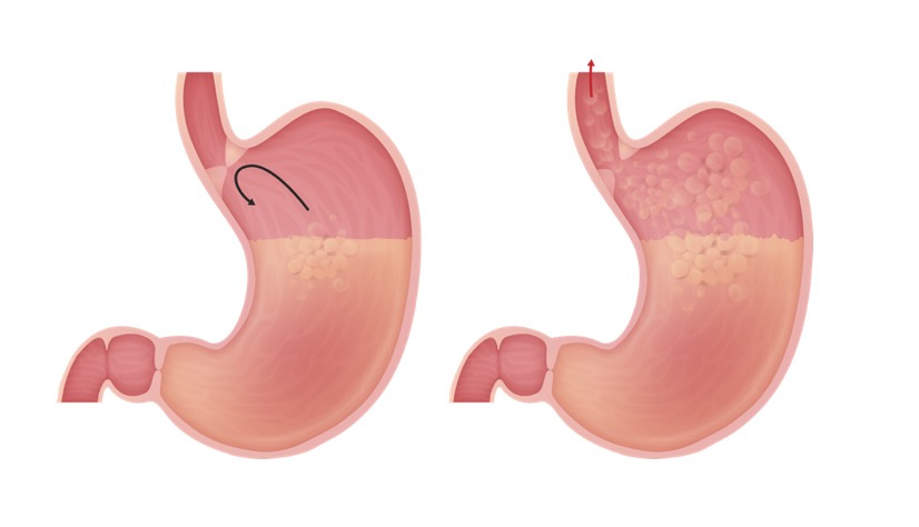 Gastroesophageal Reflux Disease Gerd Concise Medical Knowledge 