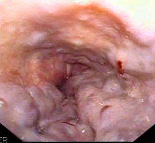 Cirrose de varizes esofágicas