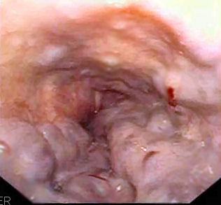 Esophageal varices cirrhosis