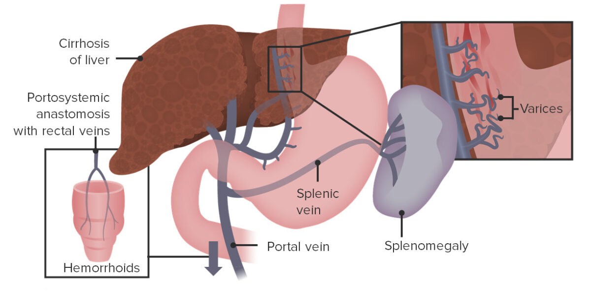 Esophageal varices, splenomegaly, and rectal varices in portal hypertension