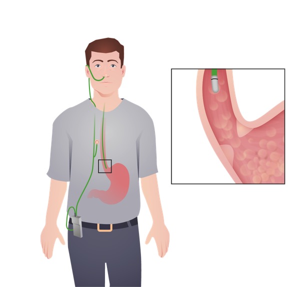 Ambulatory 48 Hour Ph Test Peninsula Gastroenterology