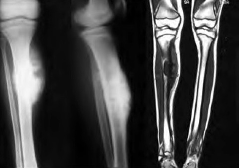 Ewing’s sarcoma of proximal one-third diaphysis of right tibia