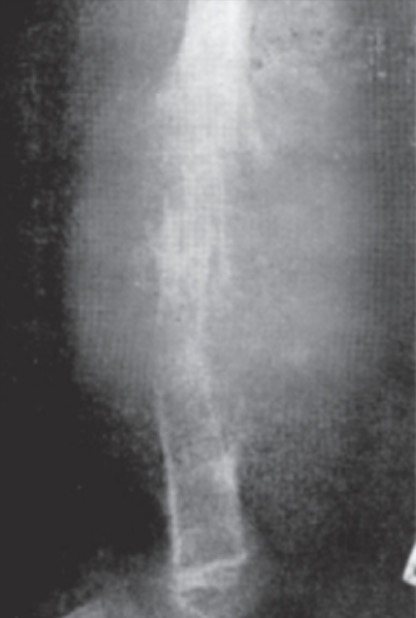 Ewing's sarcoma of the femur