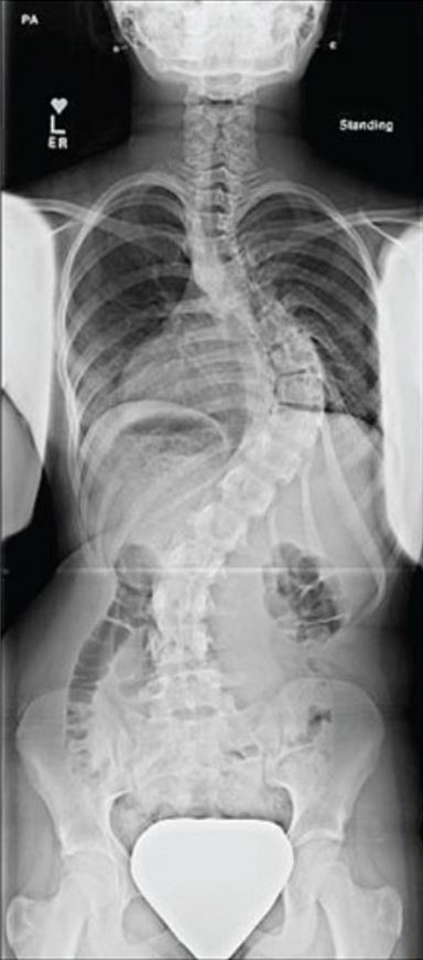Example of an x-ray of a patient with thoracic levoscoliosis