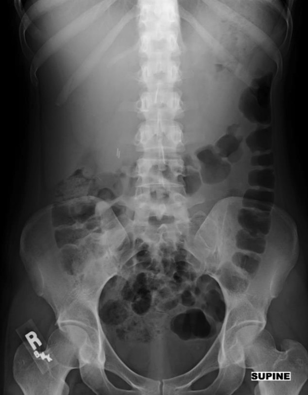 Radiografía de abdomen 2 días antes de la consulta: se observa una