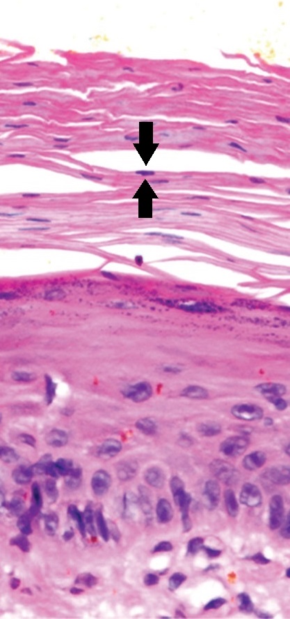 Example of an early actinic keratosis with keratinocyte dysplasia confined to the lower third of the epidermis