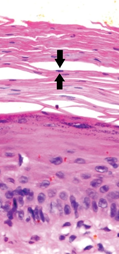 atrophic actinic keratosis