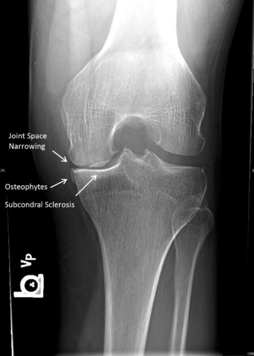 subchondral sclerosis