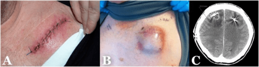 Examples of different types of surgical site infections