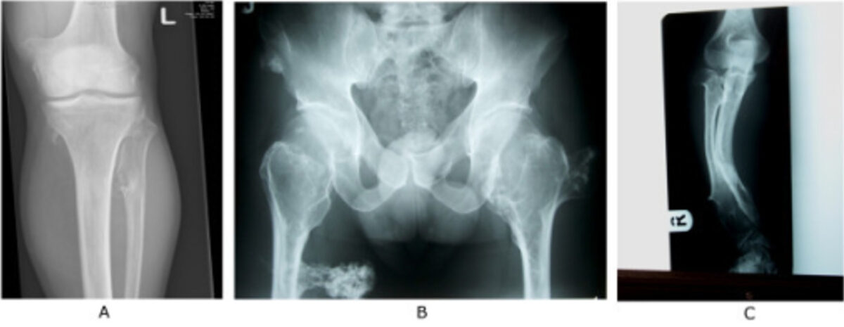 Examples of radiographs demonstrating multiple osteochondromas