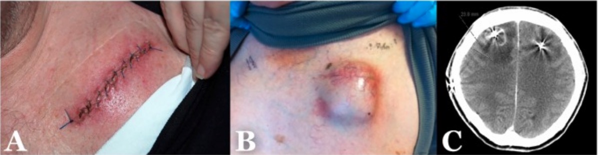 Examples of the different types of surgical infection