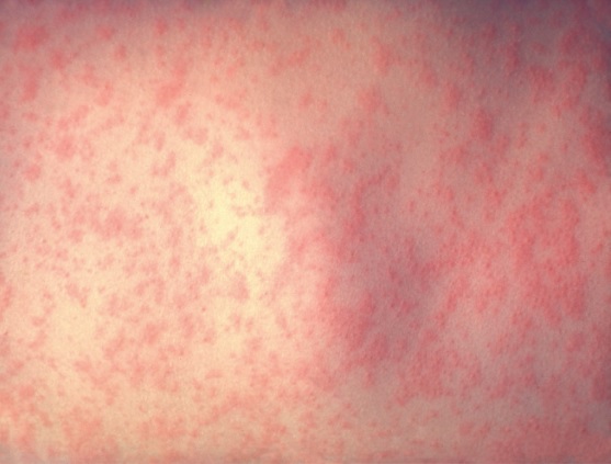 Exantema da infecção pelo vírus da rubéola