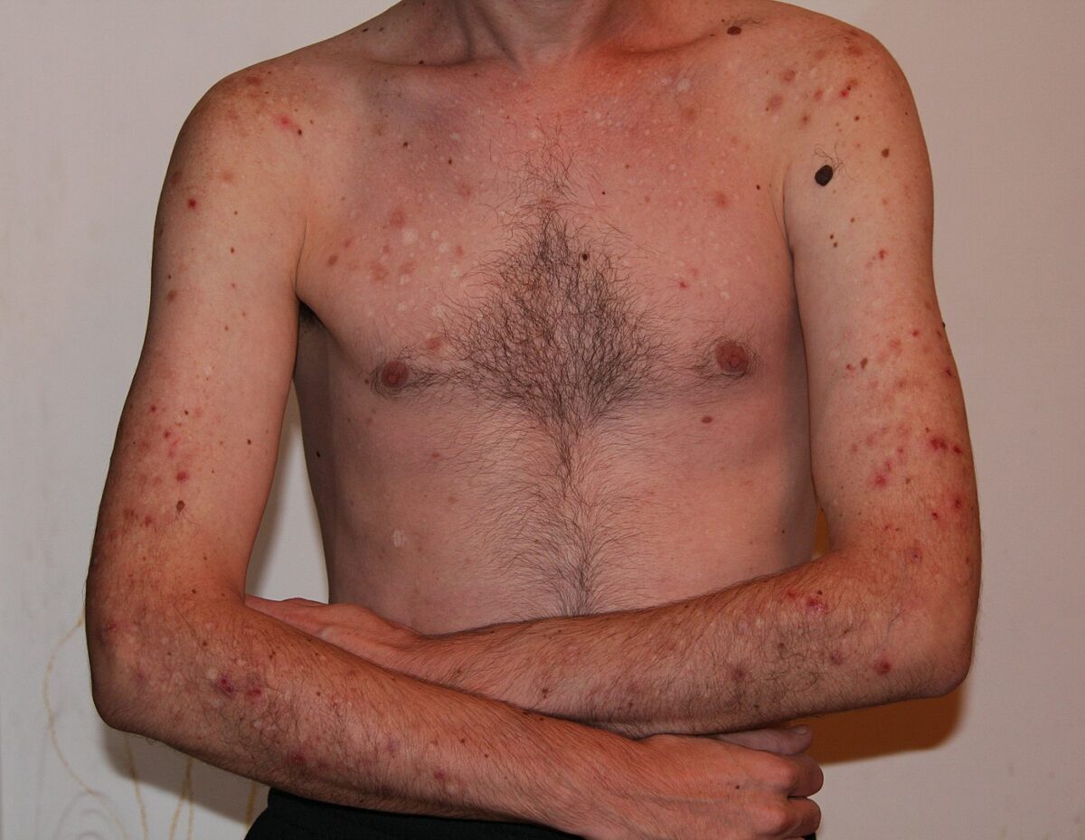 Excoriation disorder secondary to skin picking