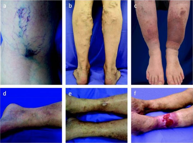 Exemplary photographs for a spectrum of clinical manifestations of chronic venous disease