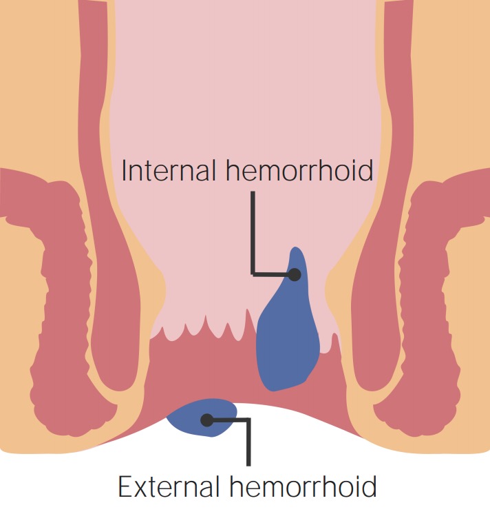 Hemorroidas externas e internas