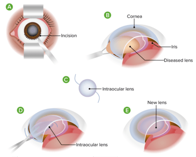 Cataracts in Adults | Concise Medical Knowledge