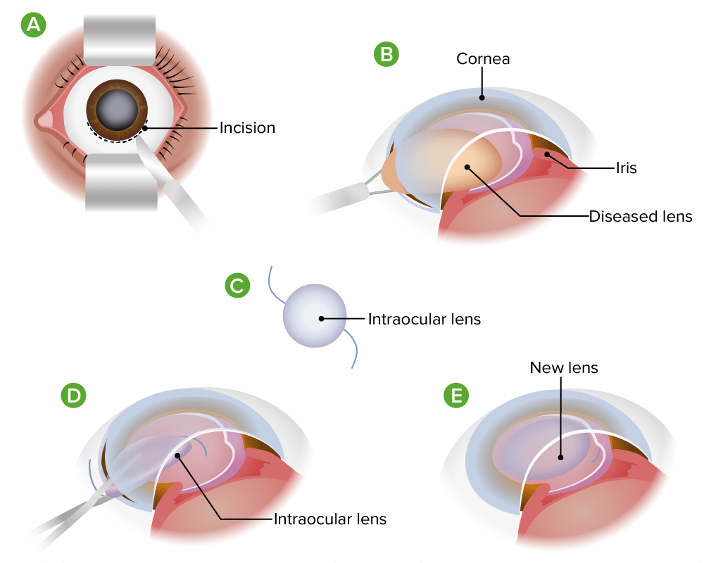 Extracapsular cataract extraction