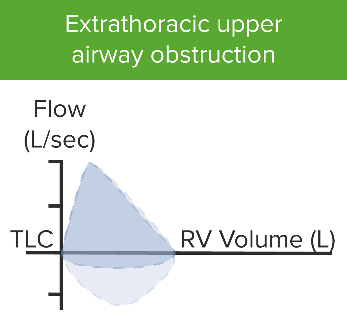 Extrathoracic upper airway obstruction (uao)