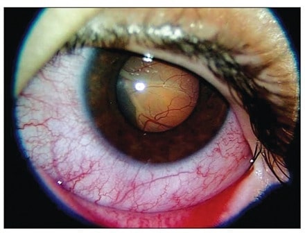 Exudative retinal detachmen