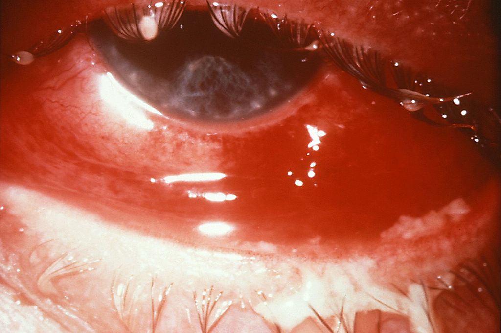 Eye infection due to gonorrhea