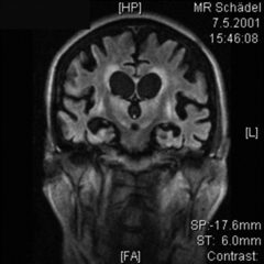 FDG PET scan to evaluate brain metabolism in a 66-year-old woman with PVS