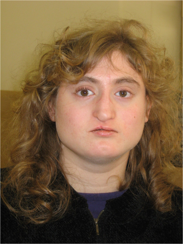 velocardiofacial syndrome facial features