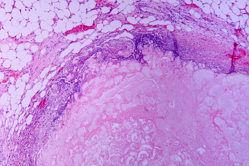 Fat tissue necrosis in acute pancreatitis