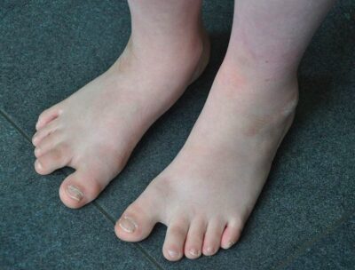 Feet of a boy with down syndrome