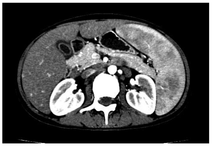 Felty syndrome on ct in a case of unexplained neutropenia