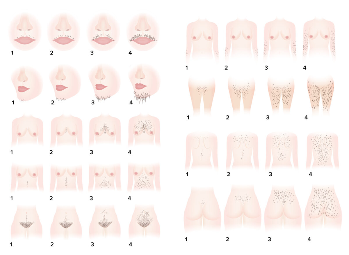 Ferriman-gallwey hirsutism scoring