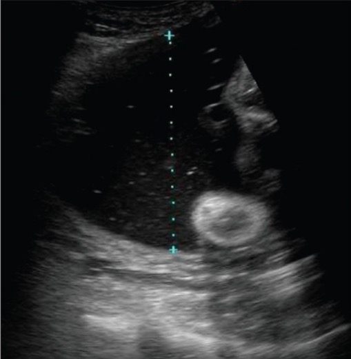 Entorno fetal: medición de una sola bolsa vertical de líquido