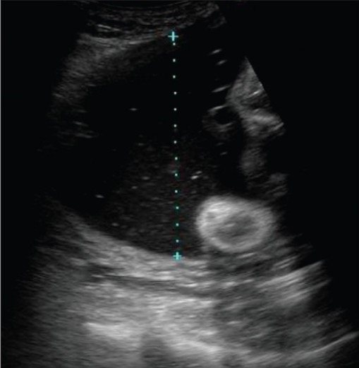 polyhydramnios ultrasound