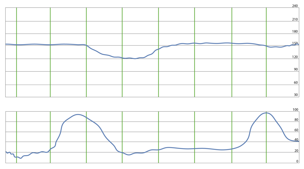 Fetal heart rate tracing demonstrating a prolonged late deceleration